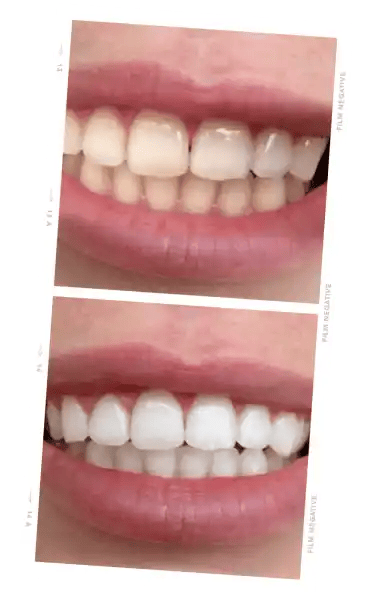 ONLYSMILE teeth whitening gel