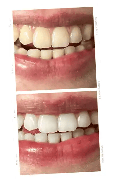 ONLYSMILE teeth whitening gel