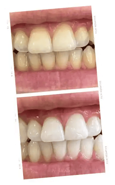 ONLYSMILE teeth whitening powder