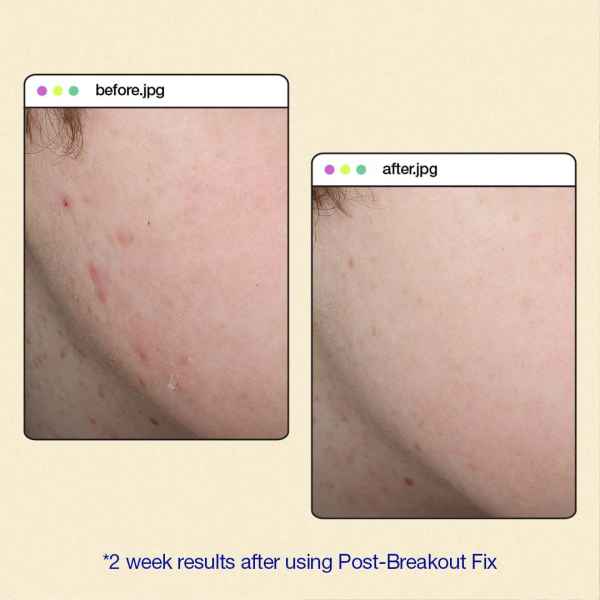 dermalogica Clear Start Post-Breakout Fix